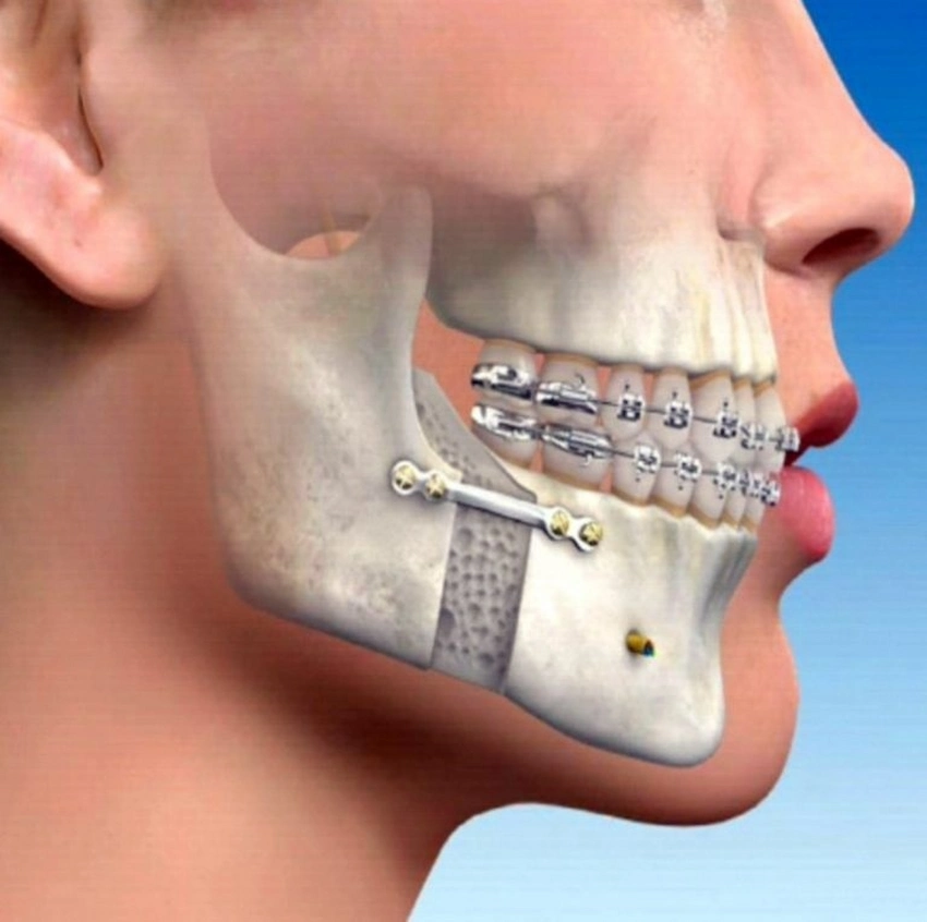 ostéotomie pour les dents
