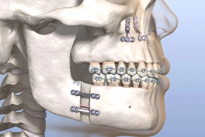 osteotomy teeth