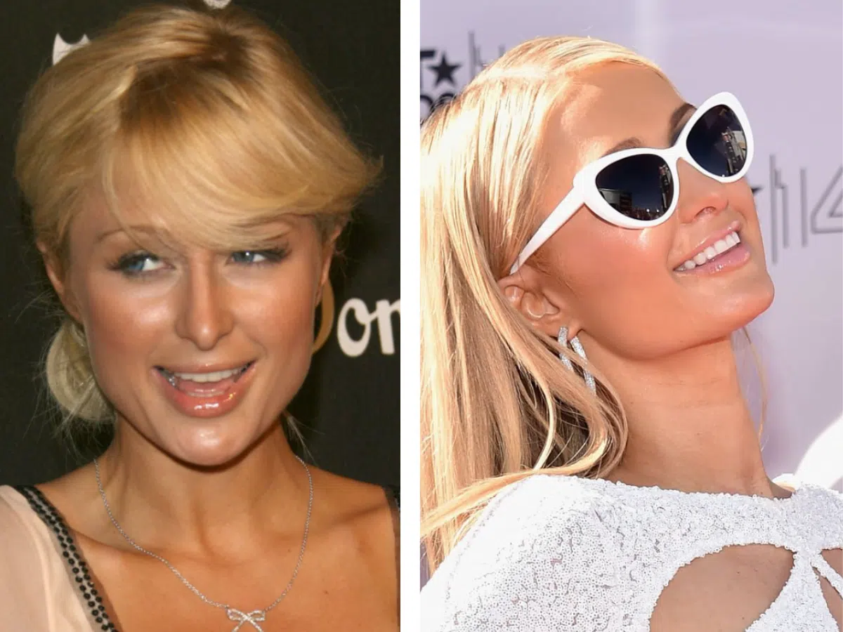 paris hilton teeth before after