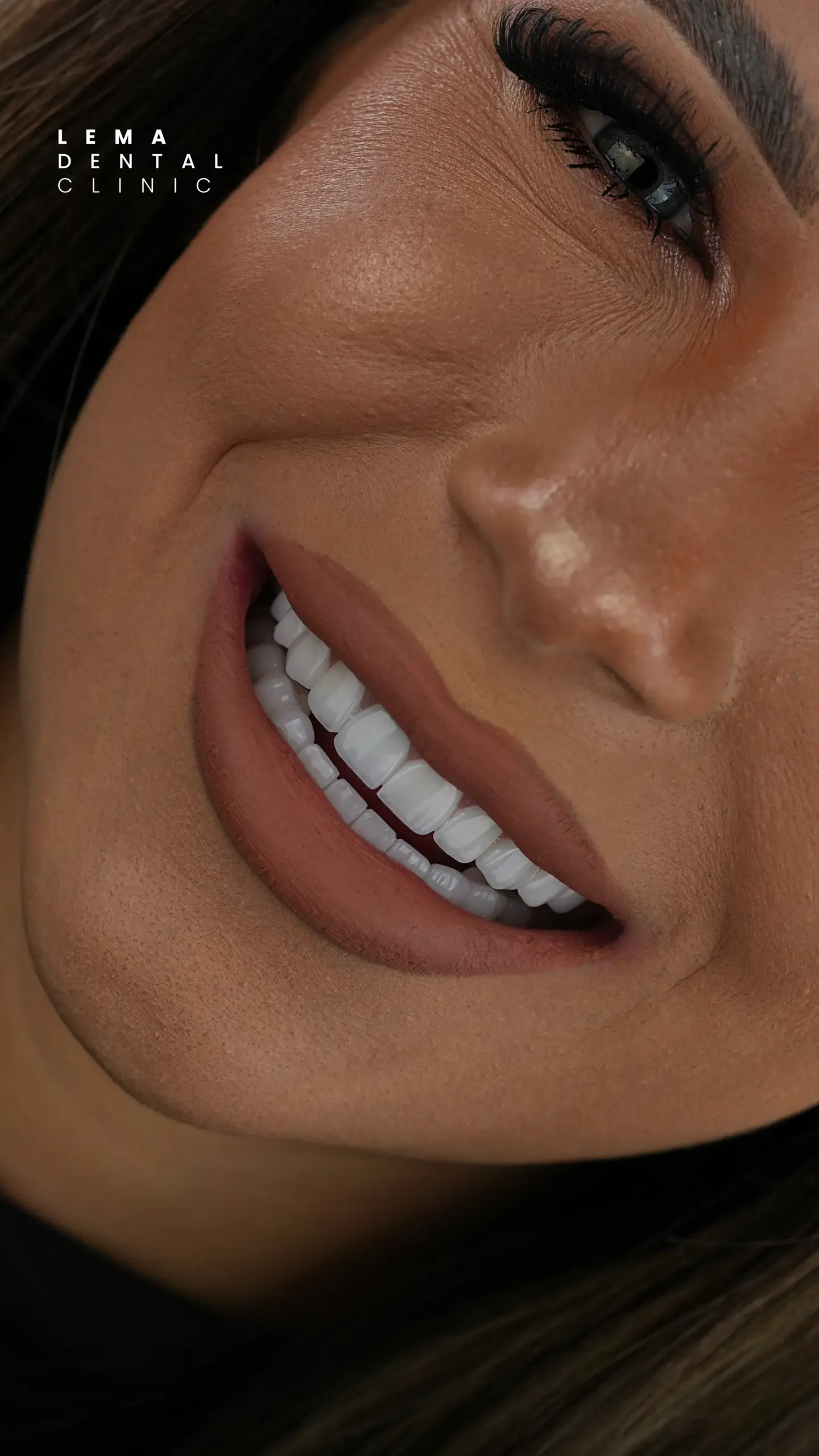 Hollywood Smile 1