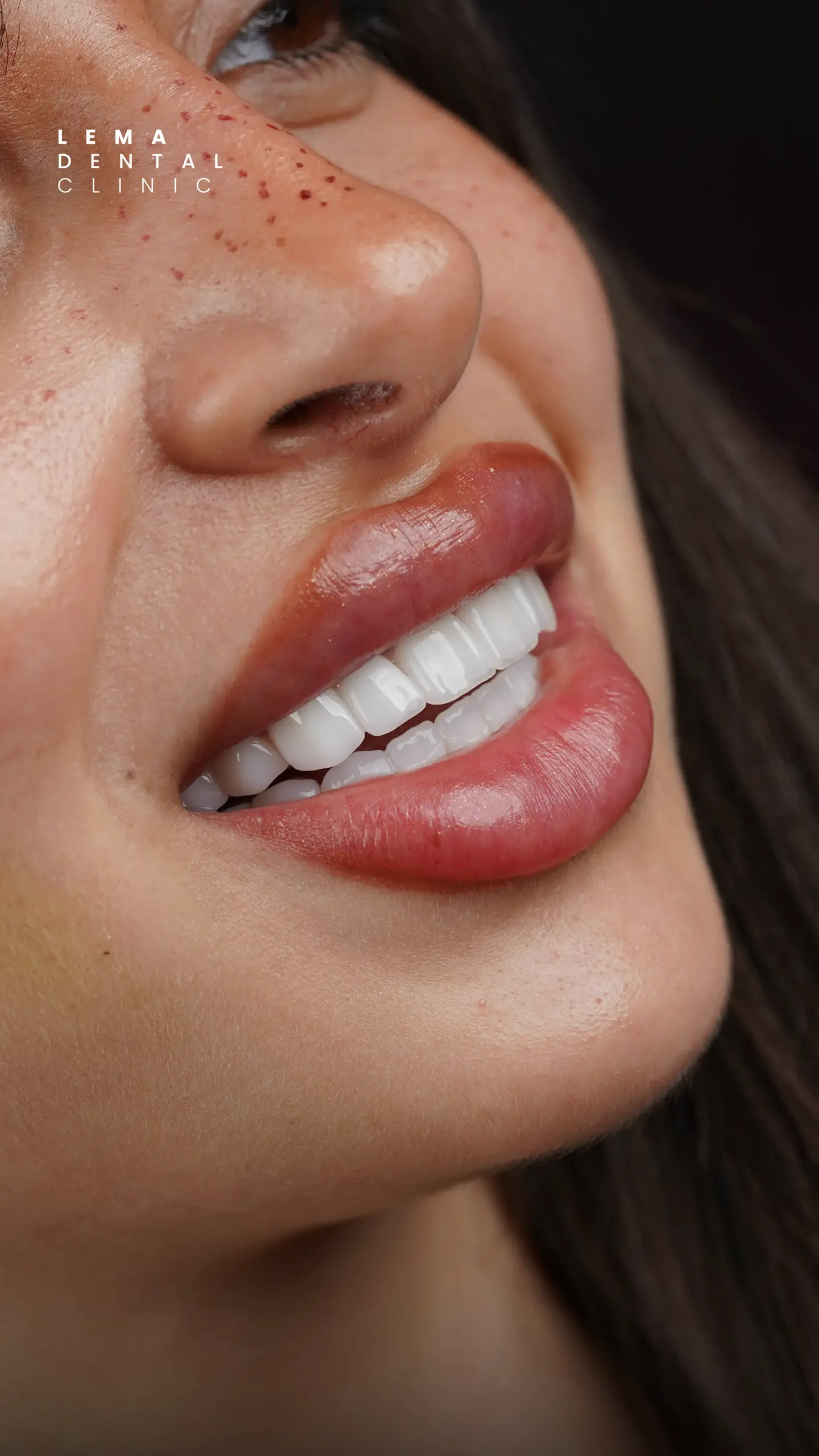 Hollywood Smile 5