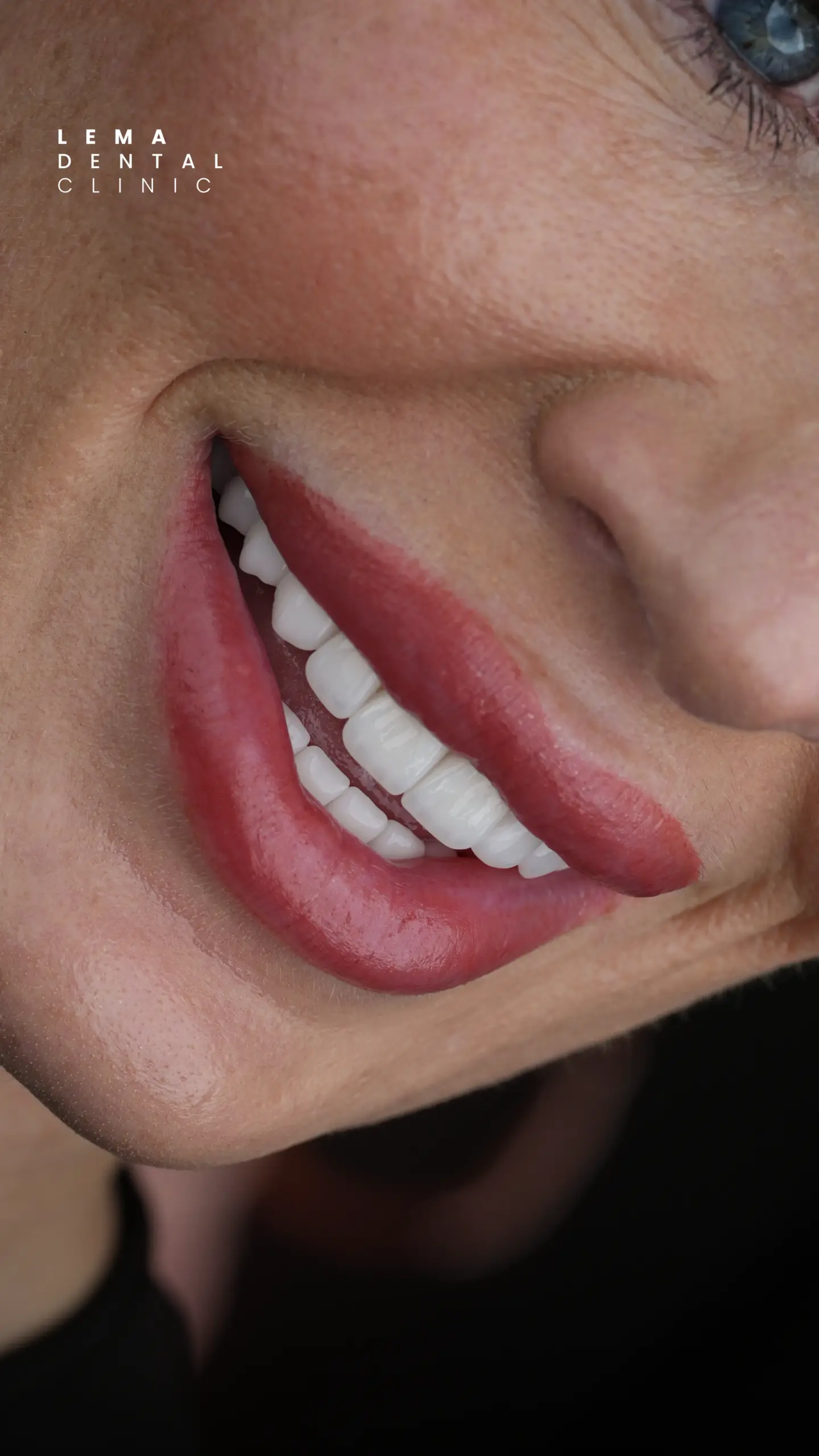 Hollywood Smile 6