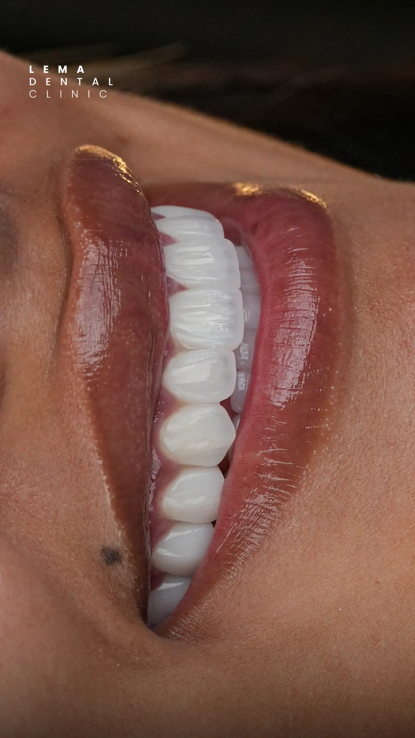 Hollywood Smile 7