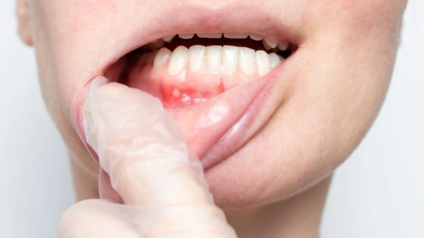 patient has oral trush