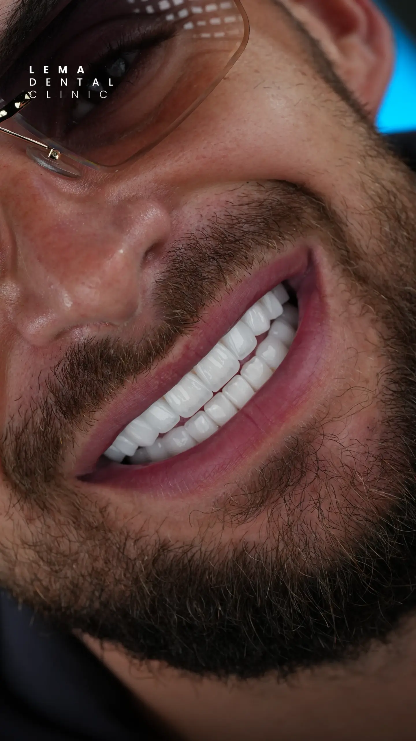 Hollywood Smile 8