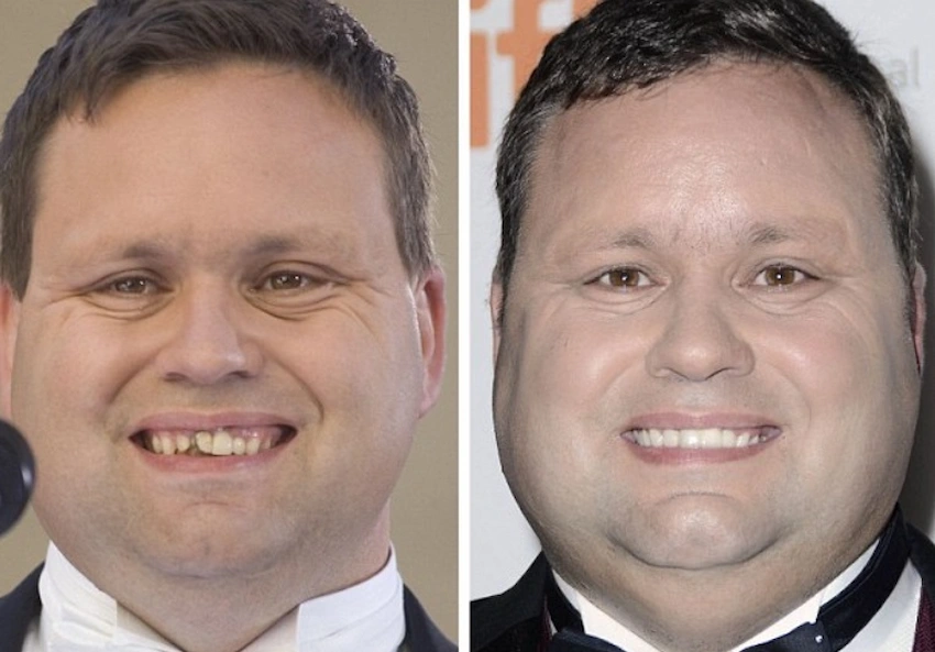 paul potts teeth