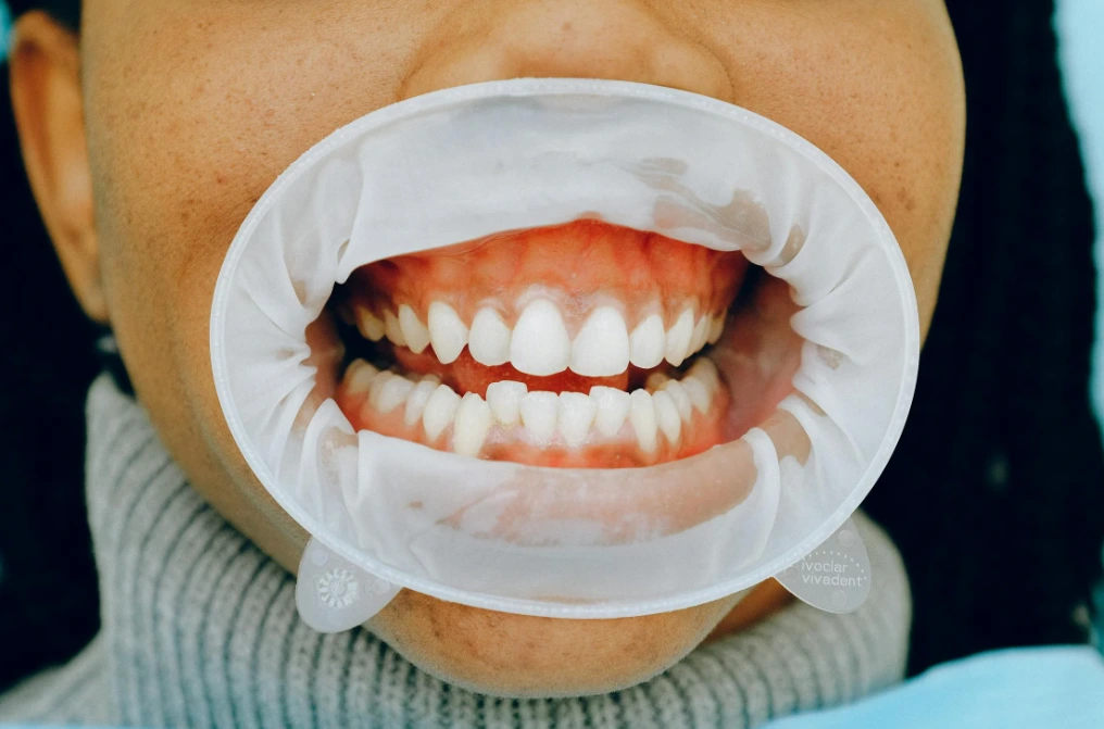 diş yanak retractor ile kişi