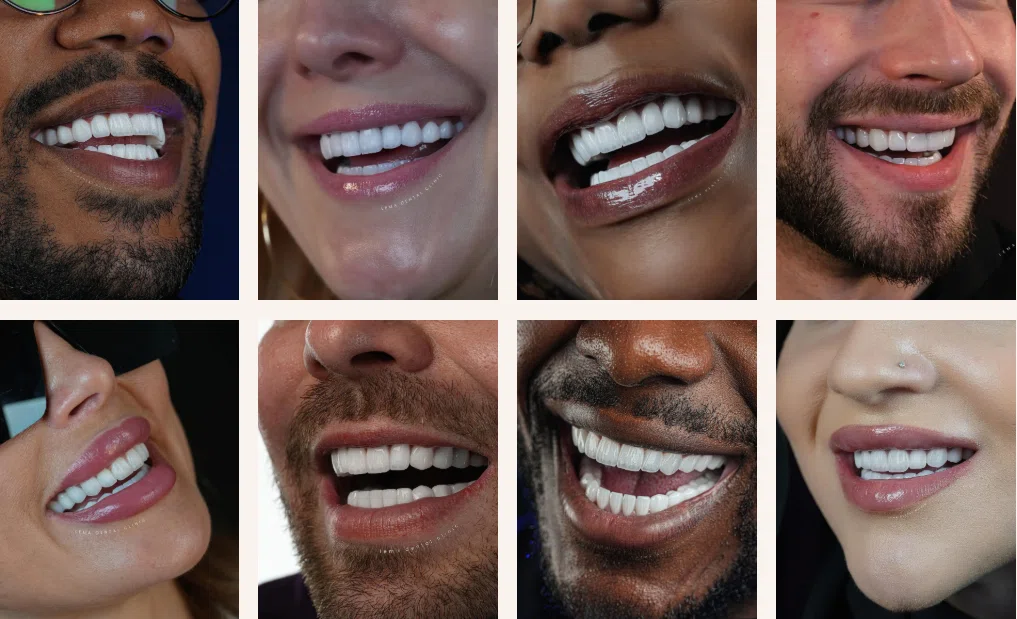 фарфоровые виниры в клинике Lema