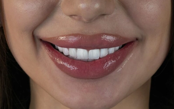 porcelain veneers procedure