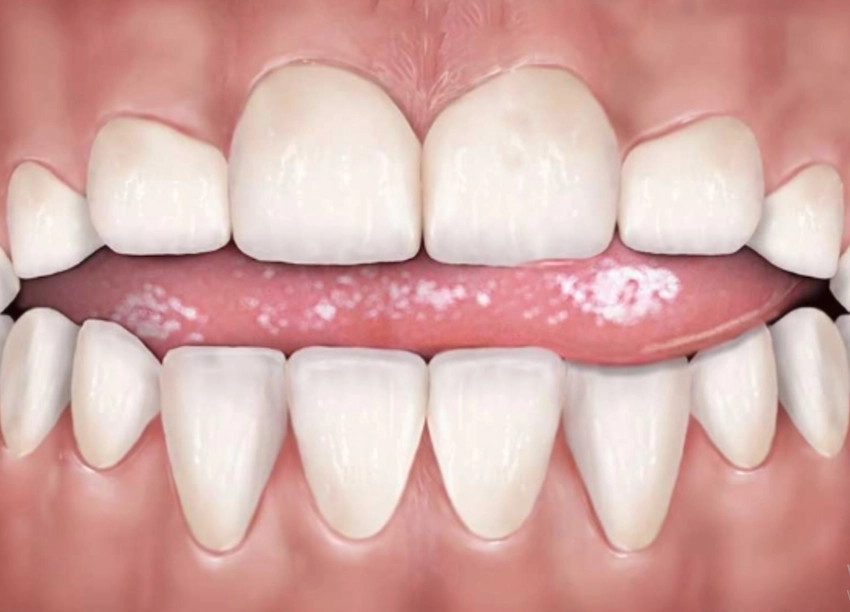 appuyer la langue sur les dents