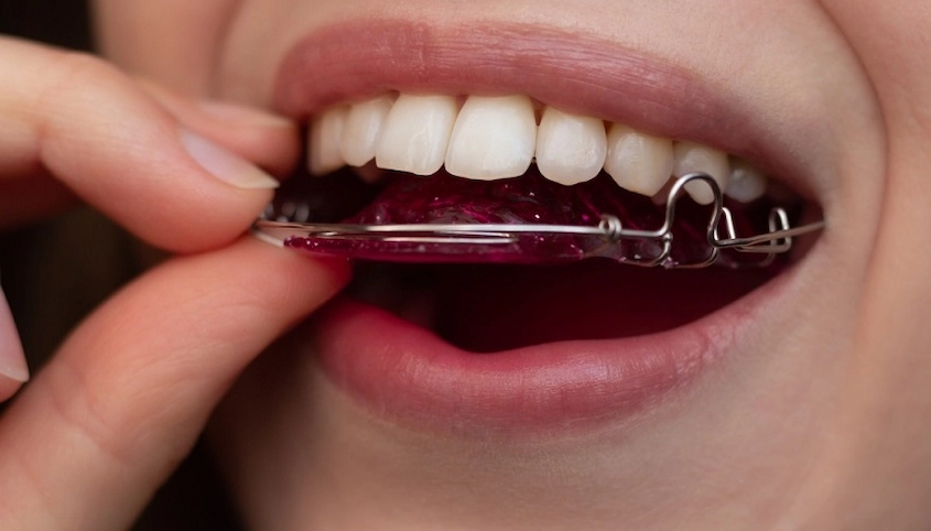 svantaggi delle mascherine dentali
