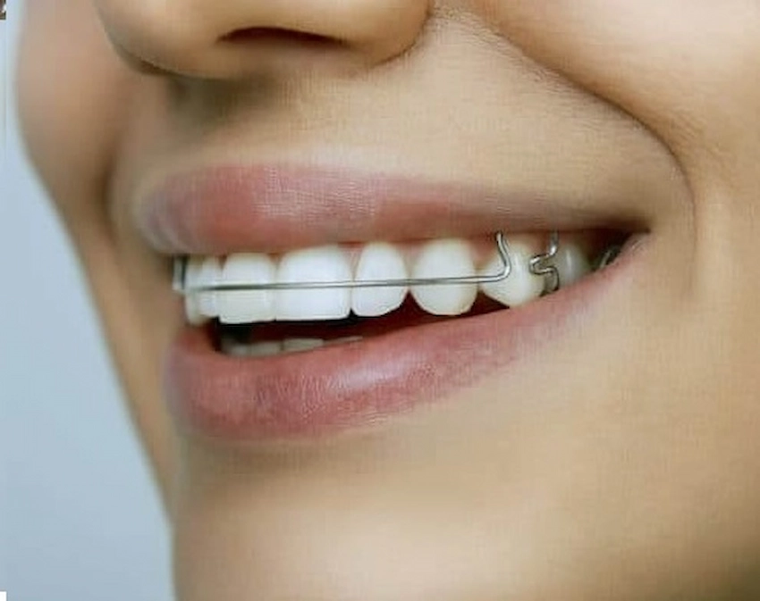 retainer teeth