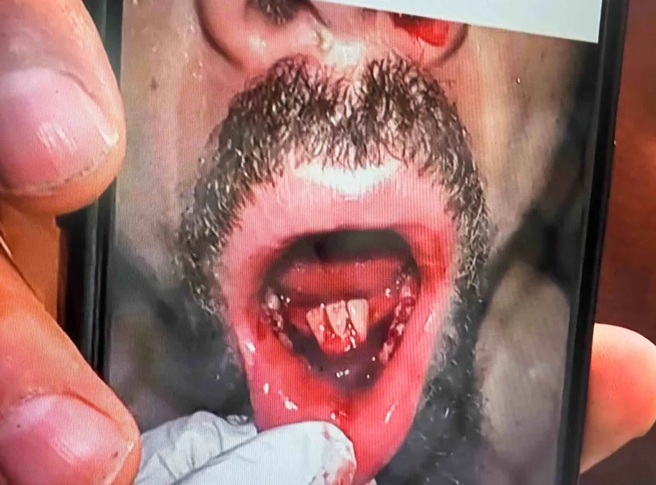 denti di robert whittaker