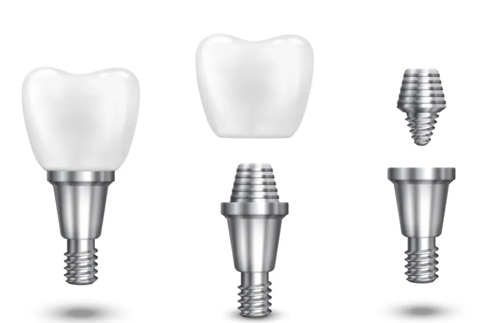 vidalı olmayan diş implantları