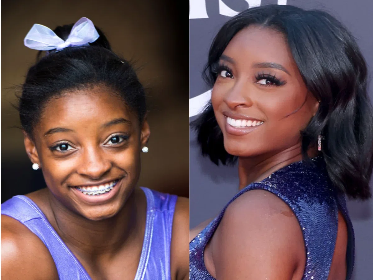 simone biles teeth before after