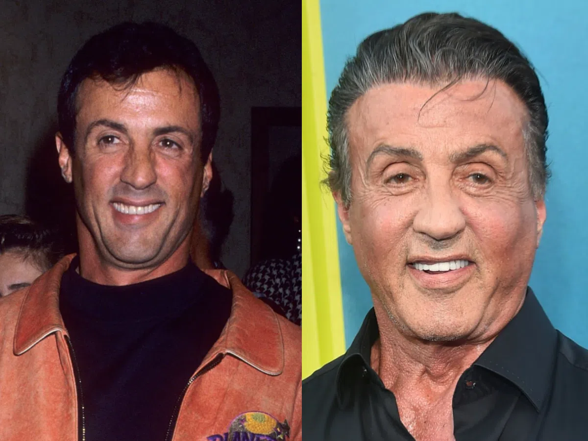 sylvester stallone teeth before after