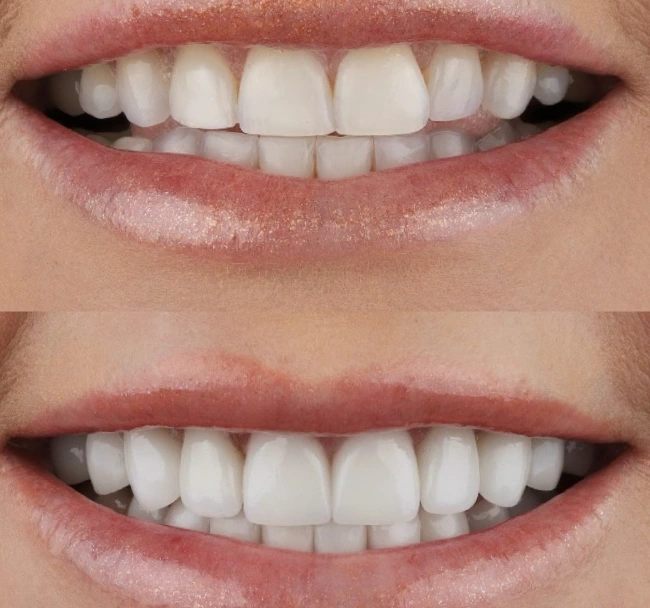 tamra judge teeth
