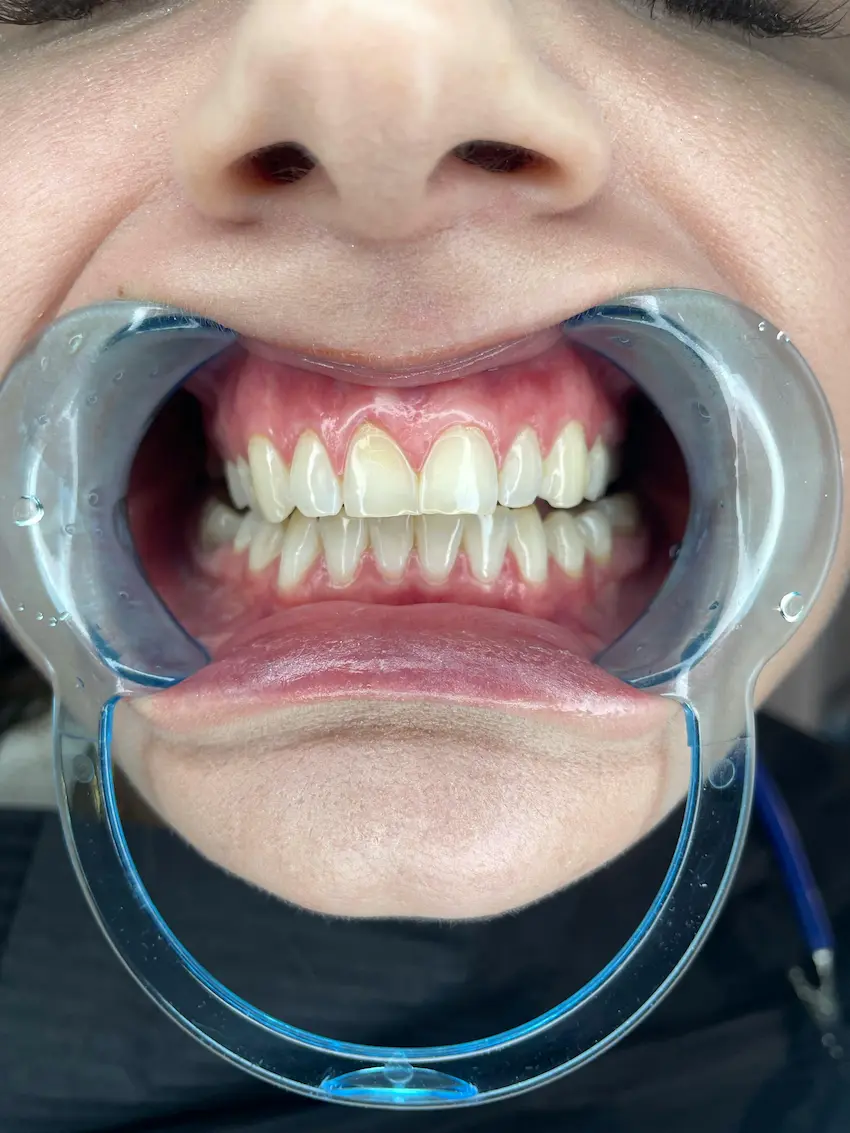 teeth