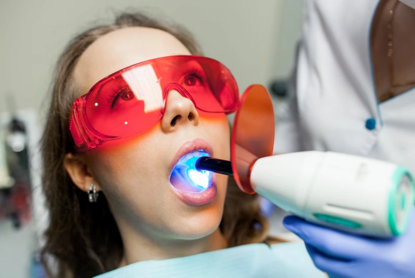 blanchiment des dents