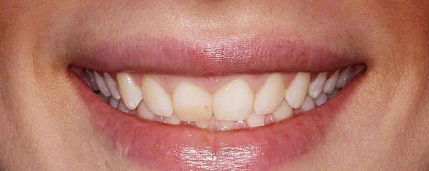 dents inclinées vers l'intérieur