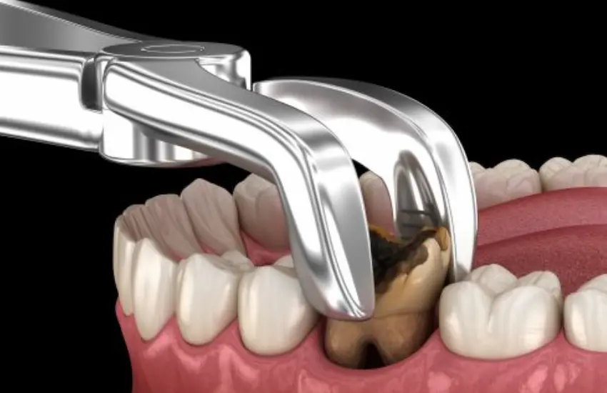 caries dental