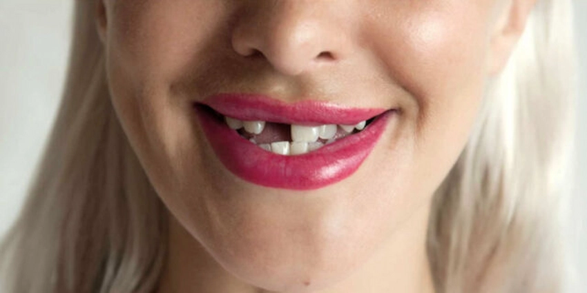 perte de dents