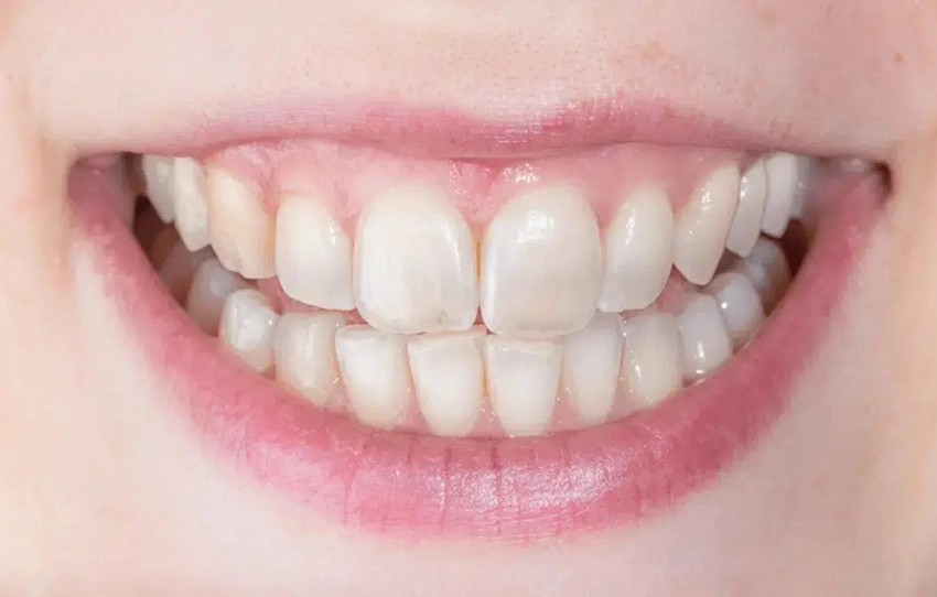 transparent teeth causes