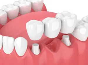 types of bridges for teeth