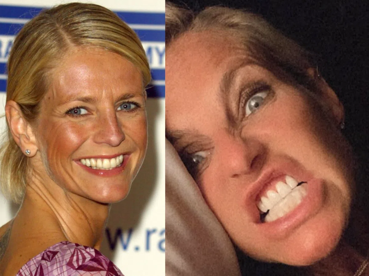 ulrika jonsson teeth before after