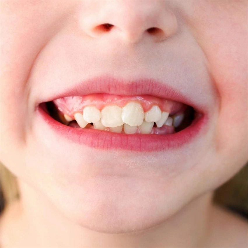 che cosa sono i denti storti