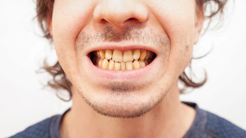 what are the effects of smoking on oral and dental health