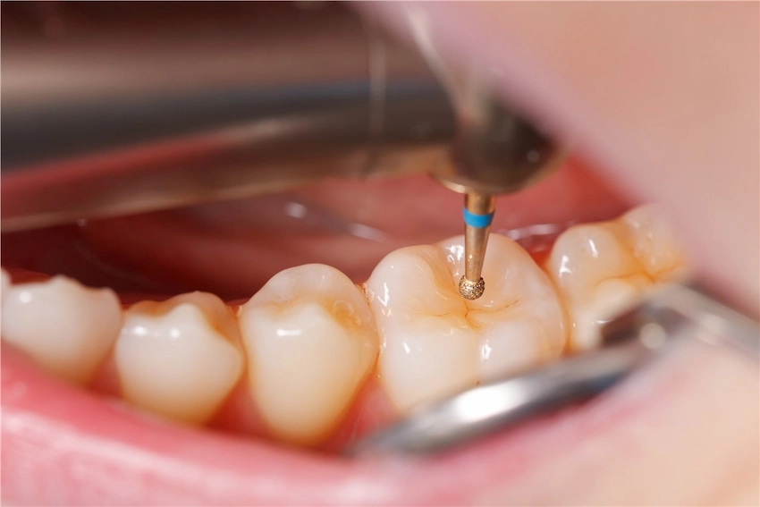 cuáles son los síntomas de la muerte del nervio dental