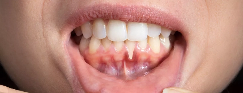 what causes periodontitis