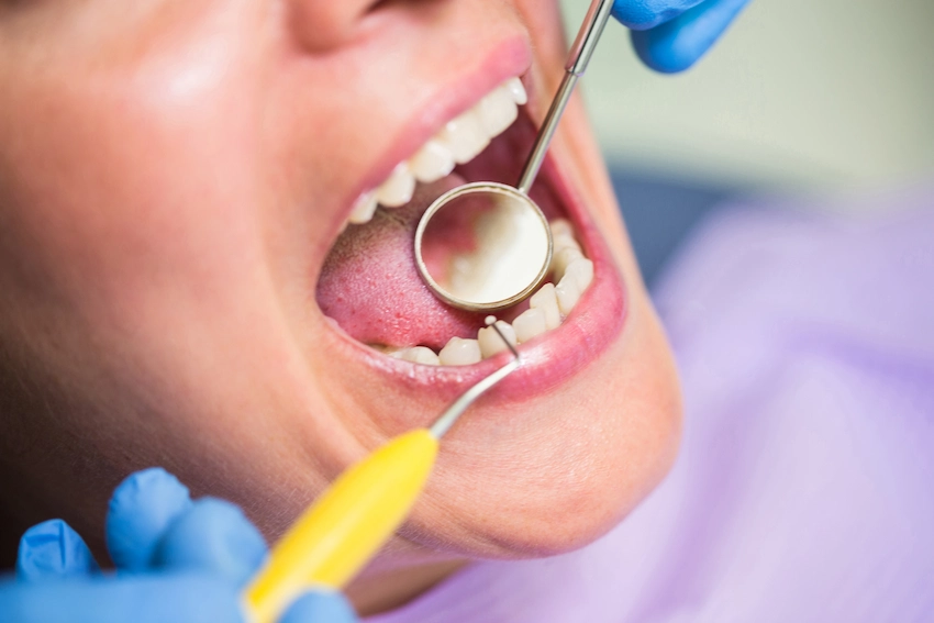 cosa è un'otturazione dentale