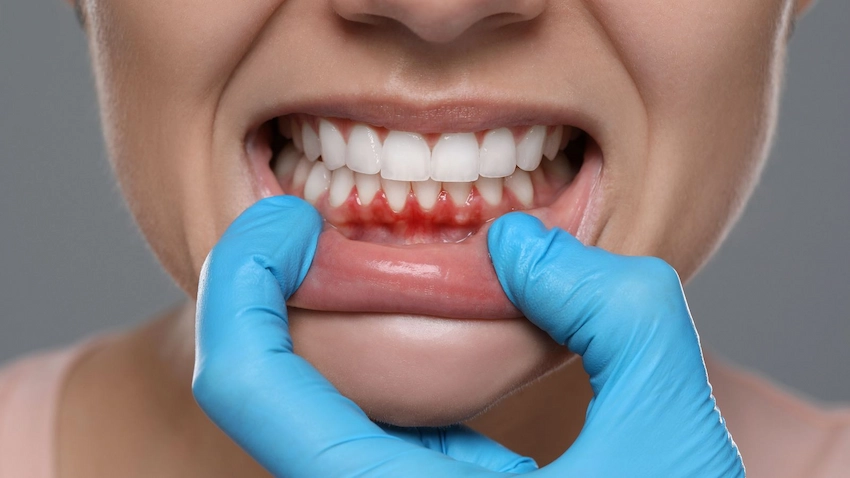 what is periodontitis disease and its signs