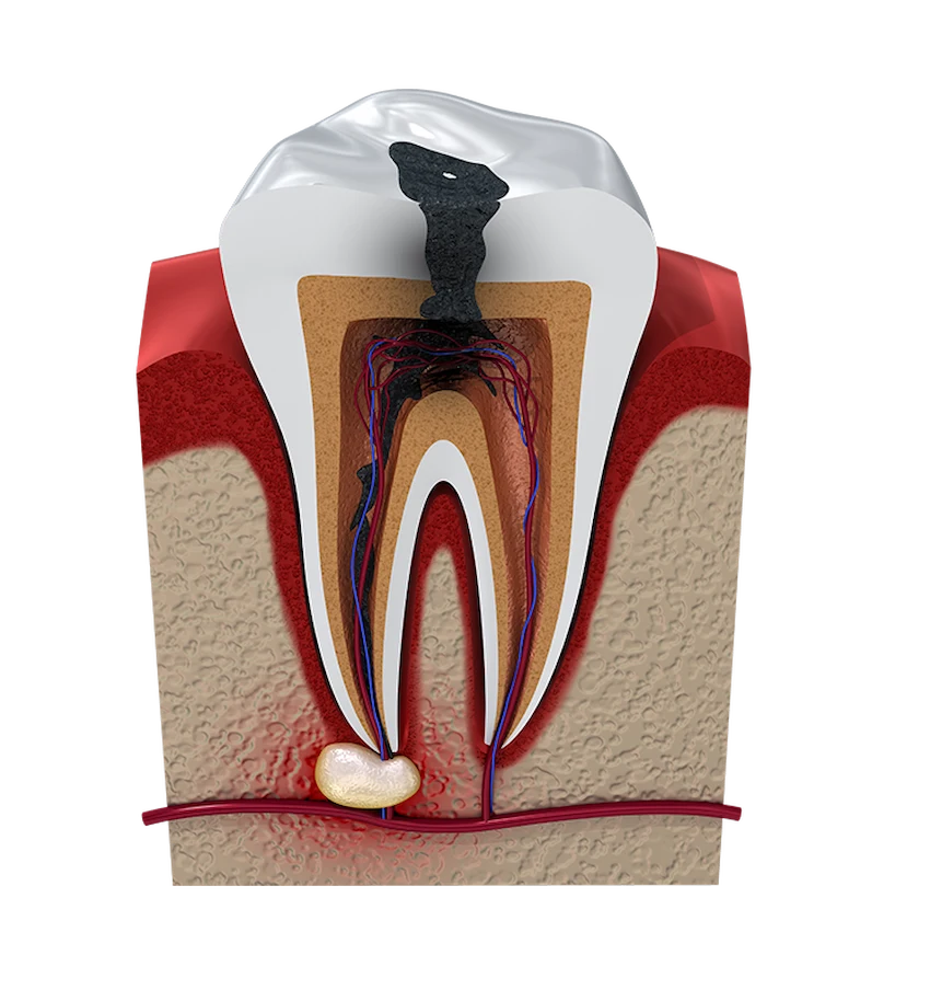 what is root infection