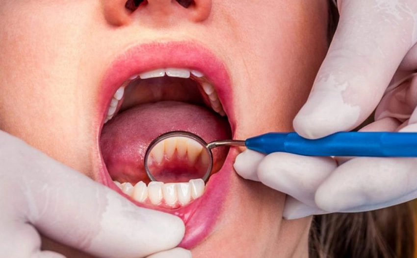 what is tooth root decay