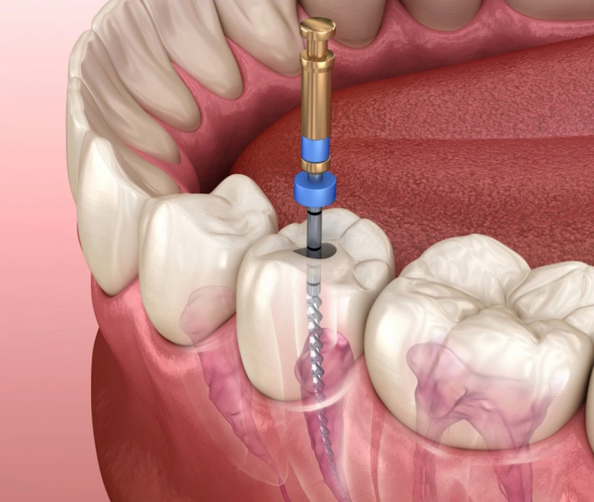 what the recovery time for root infection