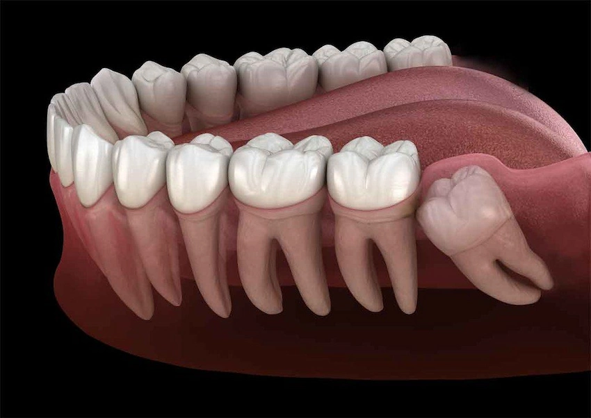 cuando los dientes impactados afectan la estética de la sonrisa