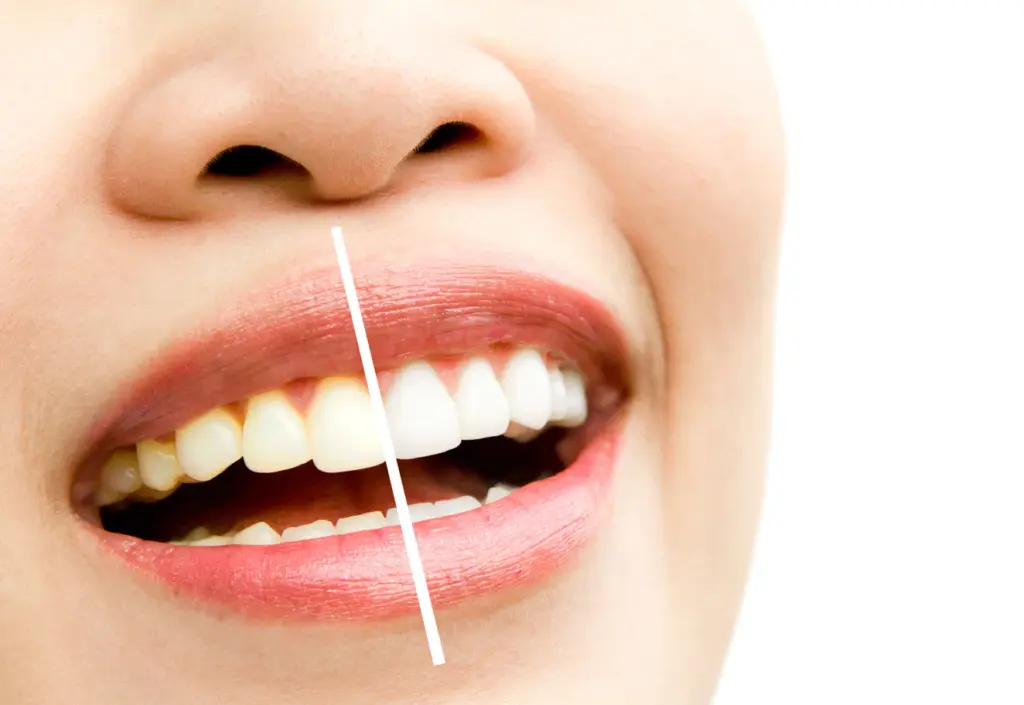sbiancare i denti