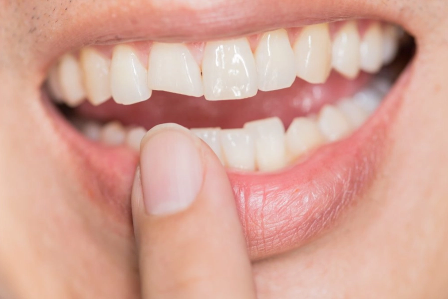 why are my teeth chipping