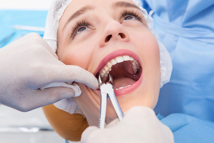 por qué ocurre la caries en la raíz del diente