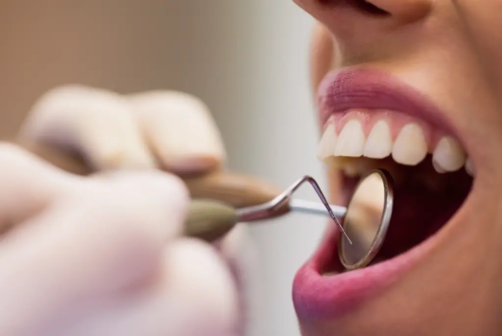 rimozione dei denti del giudizio