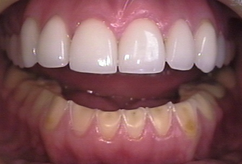 worn teeth