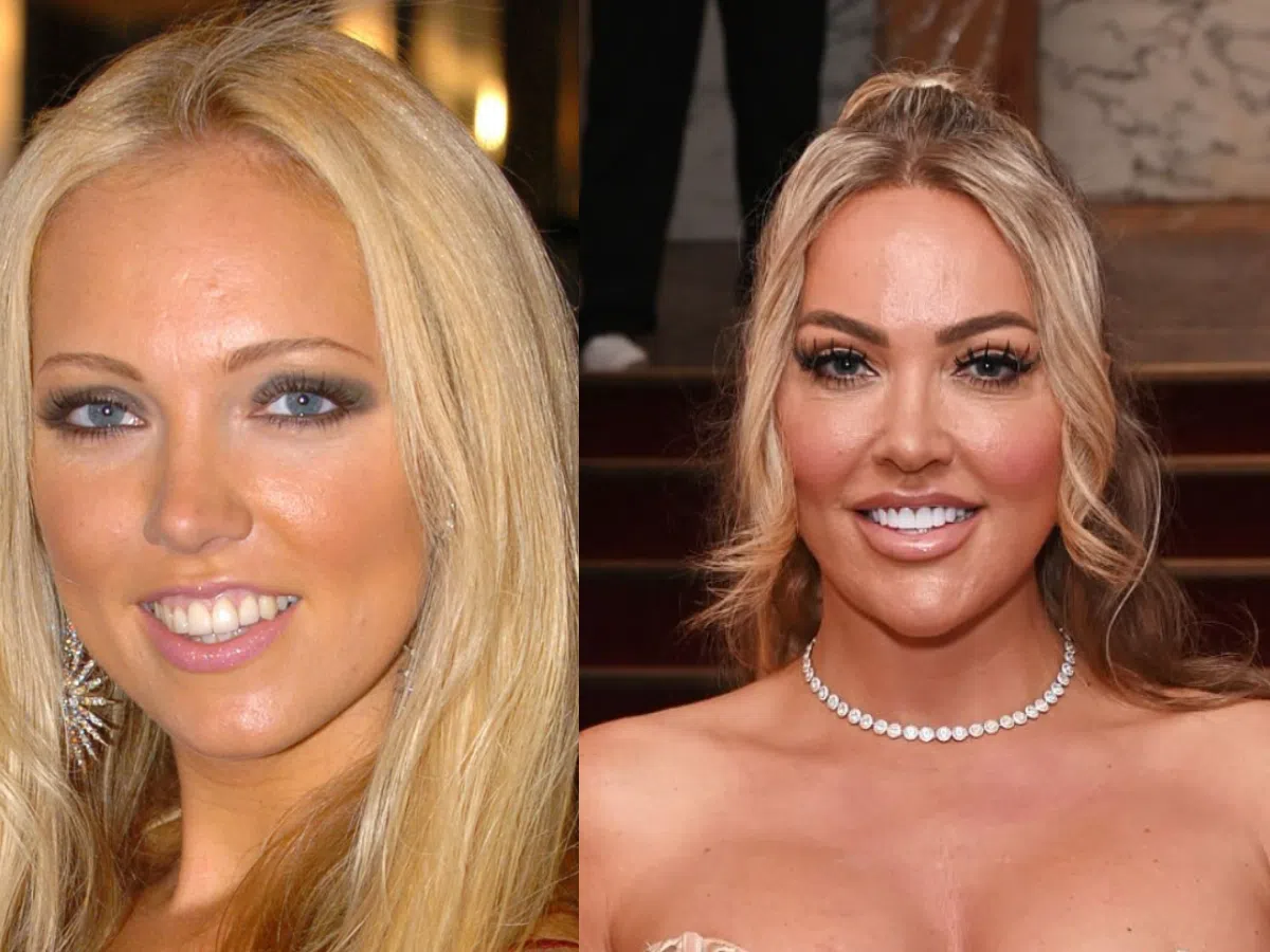 aisleyne horgan wallace teeth before after