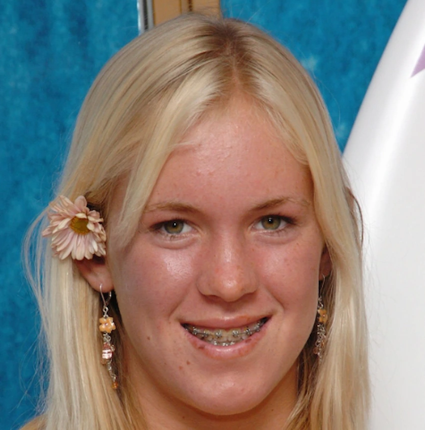 bethany hamilton teeth 2005