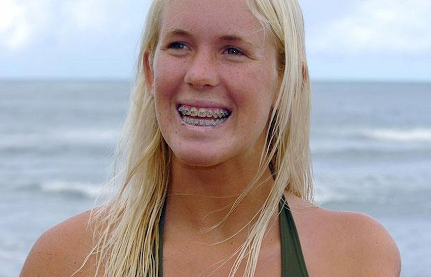 bethany hamilton teeth before after