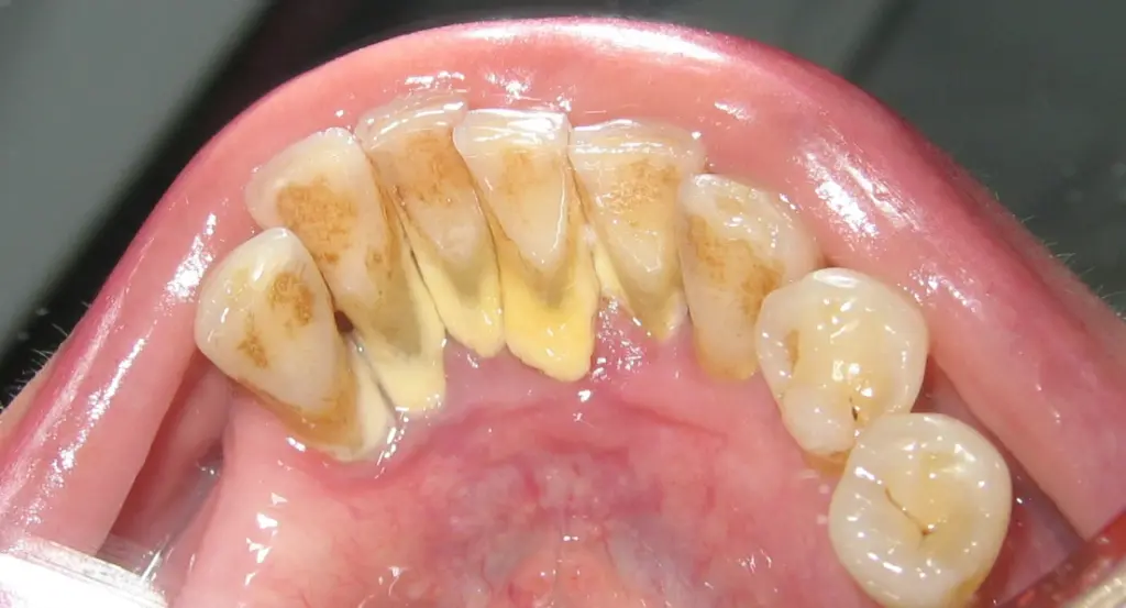 usuwanie kamienia nazębnego