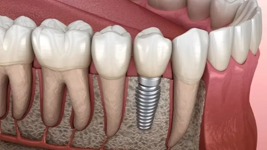 dental implants