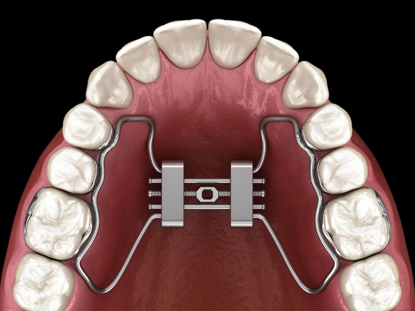 expander teeth